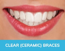 Clear Aligners