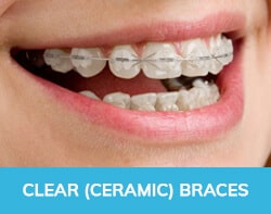 Ceramic Braces