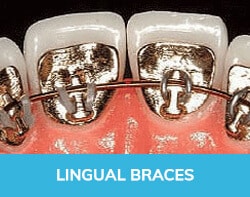 Lingual Braces