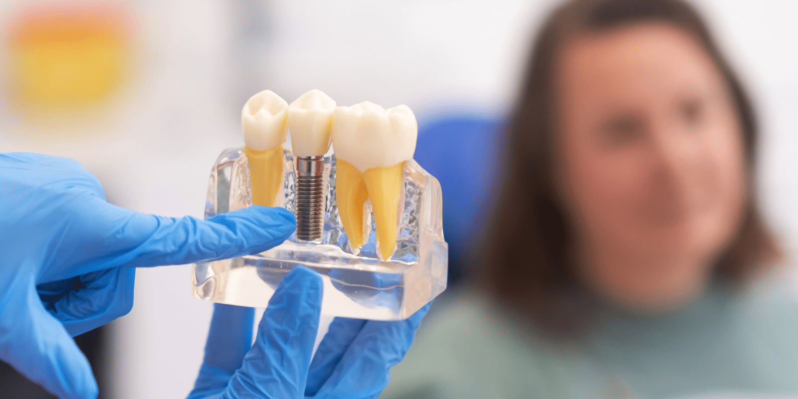 guide to caring for dental implants