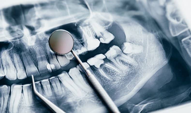 types of dental bone grafts